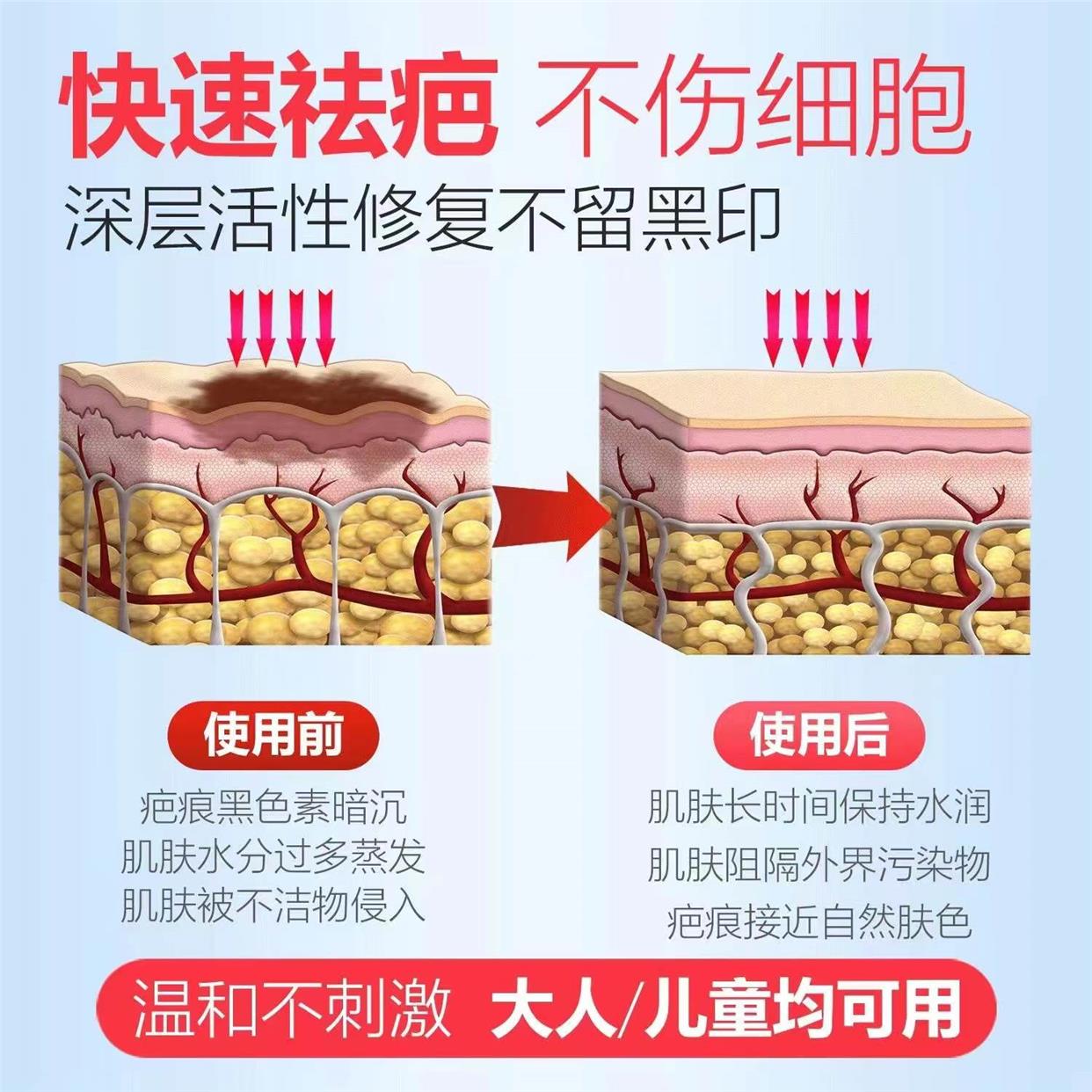 摔伤擦伤祛疤膏去疤痕修复除疤膏儿童伤疤划伤烫伤贴硅酮凝胶药膏