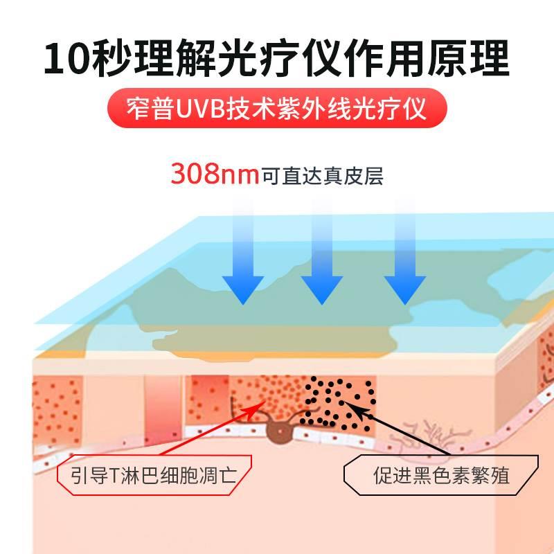 308nm准分子光疗仪 白癜风银屑病家用紫外线理疗灯医用激光治疗仪 - 图1