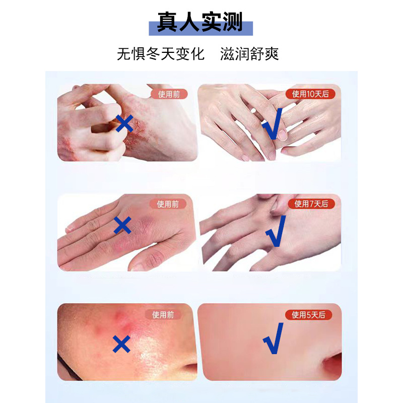 苗三叔手足冻疮膏护理滋润脱皮脚后跟干裂皮肤