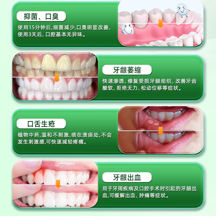 摩美得西帕依固齿泡腾片治疗药牙齿松动专用口腔牙周炎除口臭牙疼