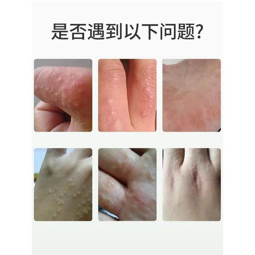 云南本草汗泡疱珍疹药膏汗状疱疹软膏汗孢疹湿疹止痒抑菌膏正品