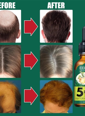 好货5PCS Ginger Hair Growth Products Natural Anti Hair Loss