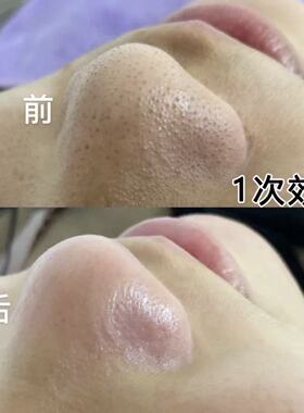 毛囊清洁净化霜乳膏美容院专用面部脸排污毛孔深层清洁污垢按摩膏