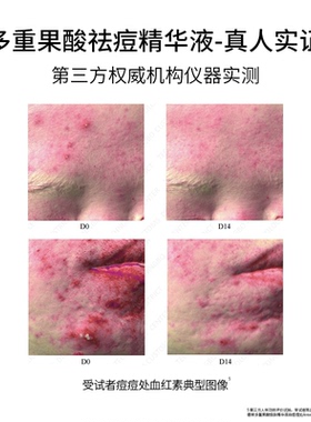 德茉复合果酸祛痘控油精华液