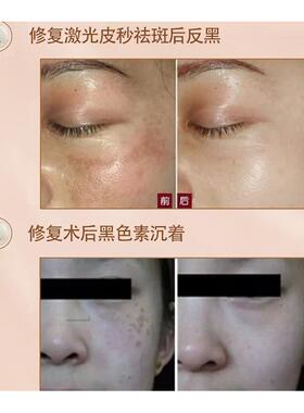 皮秒激光术后控色霜去红印淡化黑色素膏防疤痕点痣祛斑后修复因子