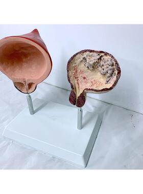 人体吸烟膀胱与健康膀胱对比模型 病理膀胱 解剖膀胱生殖系统膀胱