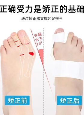 脚趾矫正器拇指外翻男女士通用