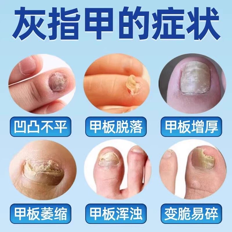 环呲护理液灰指甲搽剂官方正品脚趾甲脱甲乳膏甲癣发黄增厚非药,淘宝优惠券,粉丝福利购,淘宝优惠卷