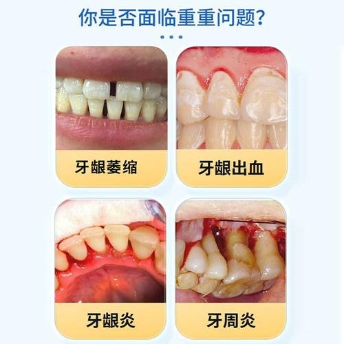 牙龈炎牙膏专牙龈出血红肿用口腔臭异味萎缩特消炎牙龈炎效修复KY - 图1