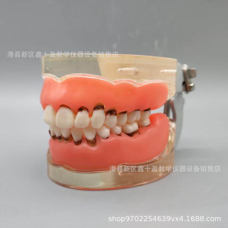 牙科病牙理模型结牙石萎缩55870牙龈缺失牙牙周洁治术练周习软牙,淘宝优惠券,粉丝福利购,淘宝优惠卷