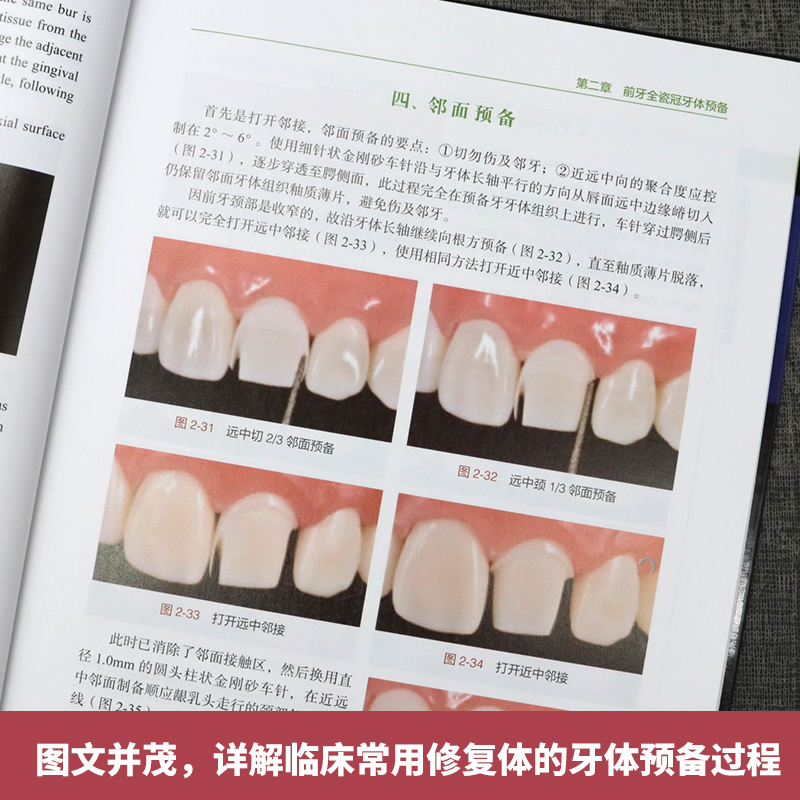 现货速发 牙体缺损修复备牙过程图解 葛少华 著 前后牙全瓷冠 贴面 嵌体 临床常用修复体的牙体预备过程 开窗型前牙瓷贴面牙体预备 - 图1