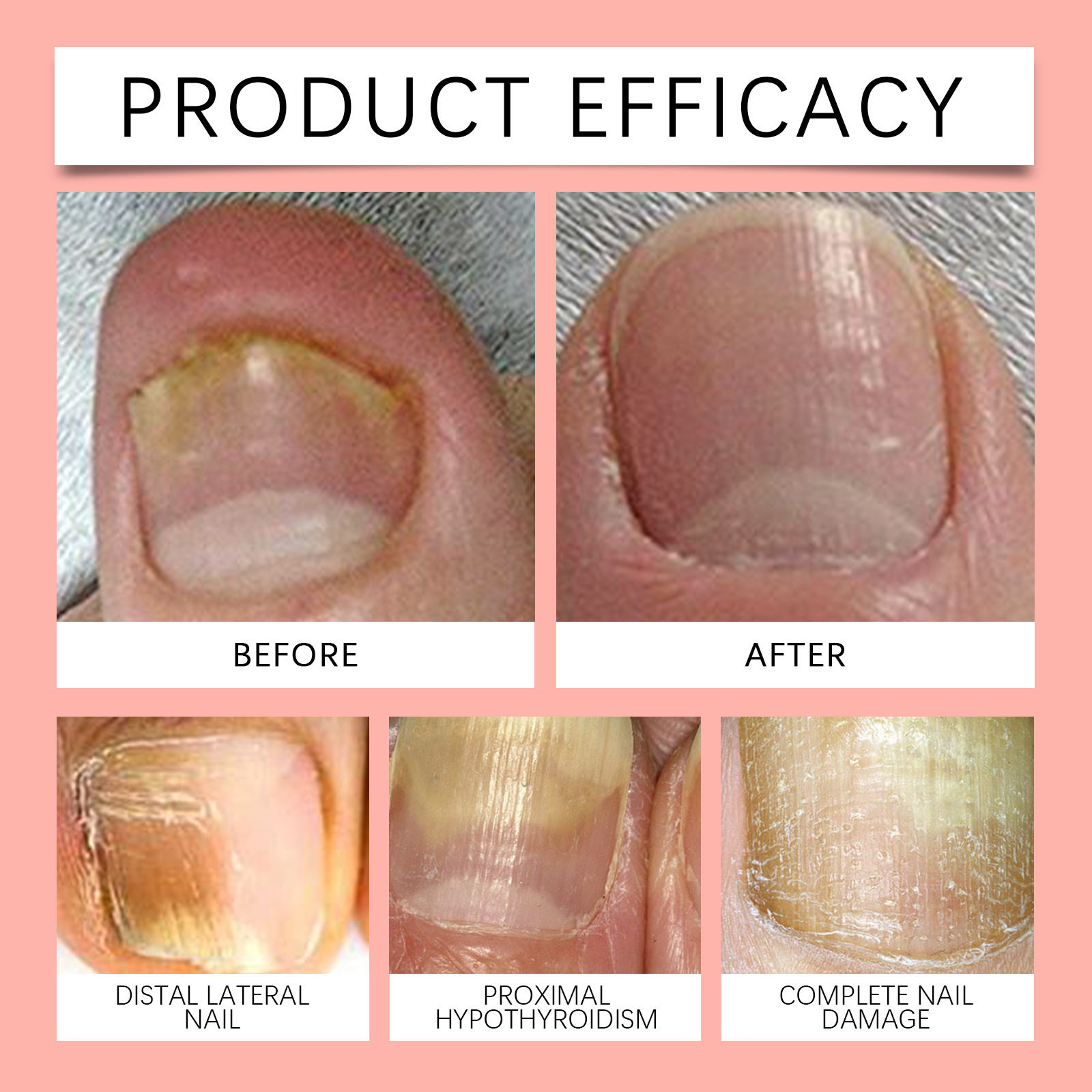 XIMONTH 指甲护理贴片 温和软化烂甲角质层滋润柔润养护护理贴,淘宝优惠券,粉丝福利购,淘宝优惠卷