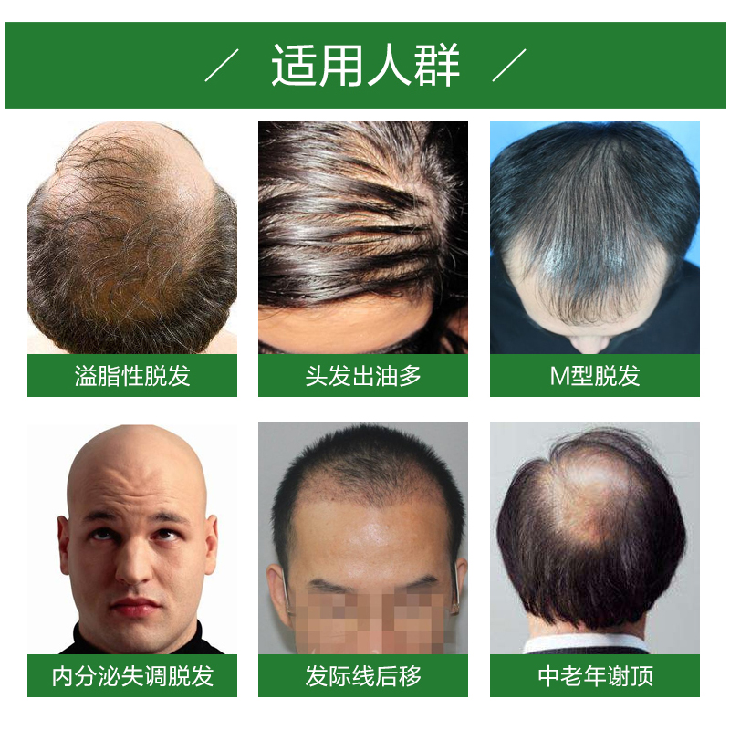 宜度海外专营店锯棕榈胶囊提取物生发防脱发前列腺保健植物非那雄胺dht阻断剂2