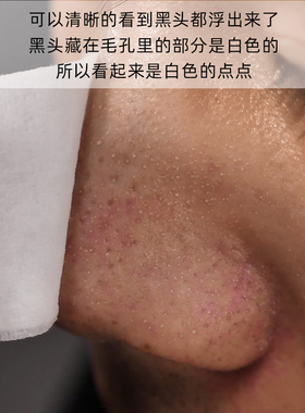 黑头导出液美容院专用粉刺