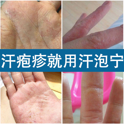 汗泡宁手指干燥粗糙手裂脱皮保湿滋润霜止痒膏吉夫宝汗疱宁正品_虎窝淘