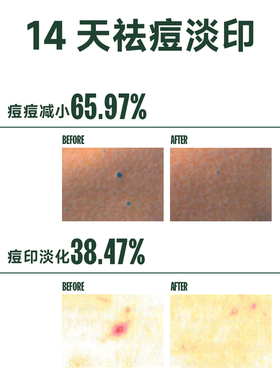 芙芙身体喷雾祛痘前胸后背粉刺