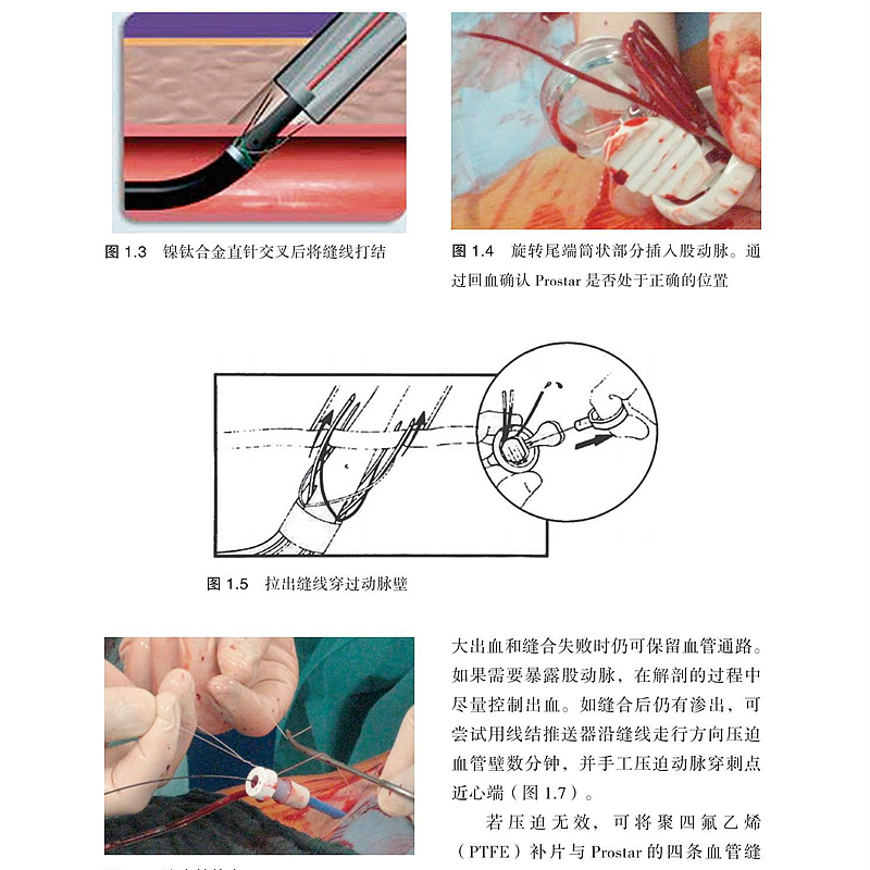 主动脉瘤腔内治疗标准与高级技术 夏印 血管腔内治疗临床血管外科手术肾下血管内修复融合成像技术肿瘤医学书籍 世界图书出版公司 - 图2