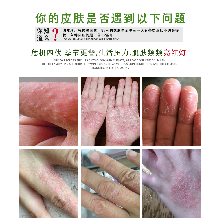 汗疱疹治疗小水泡手脱皮药膏湿疹止痒去干燥手部手癣膏真菌感染根 - 图1