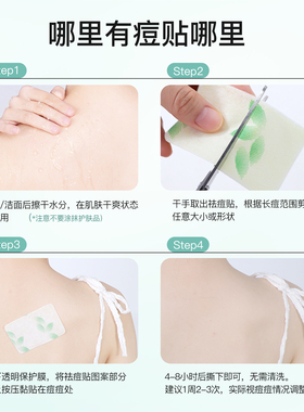 痘痘贴双专利配方专胸/背粉刺痘