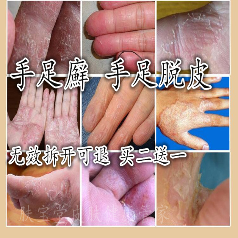 手癣真菌感染汗疱疹汗状脱皮手气软膏藓水泡手脚痒专用鹅掌风药膏