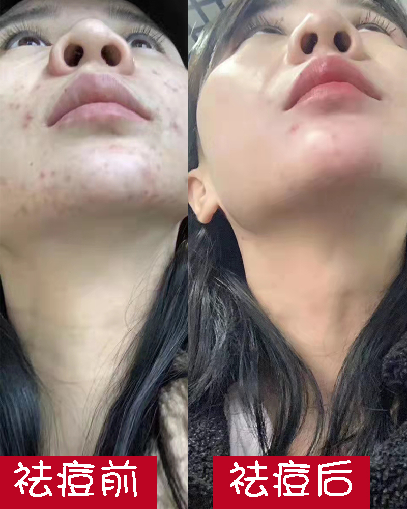 纯中药全能面霜祛痘闭口粉刺黑头白嫩保湿青春痘红肿痘印修护正品 - 图1