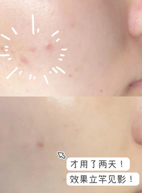 可复美稀有人参皂苷净痘次抛精华