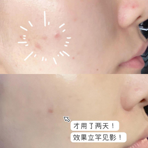 可复美秩序次抛精华面部净痘控油淡化痘印补水保湿舒缓修复乳 - 图1