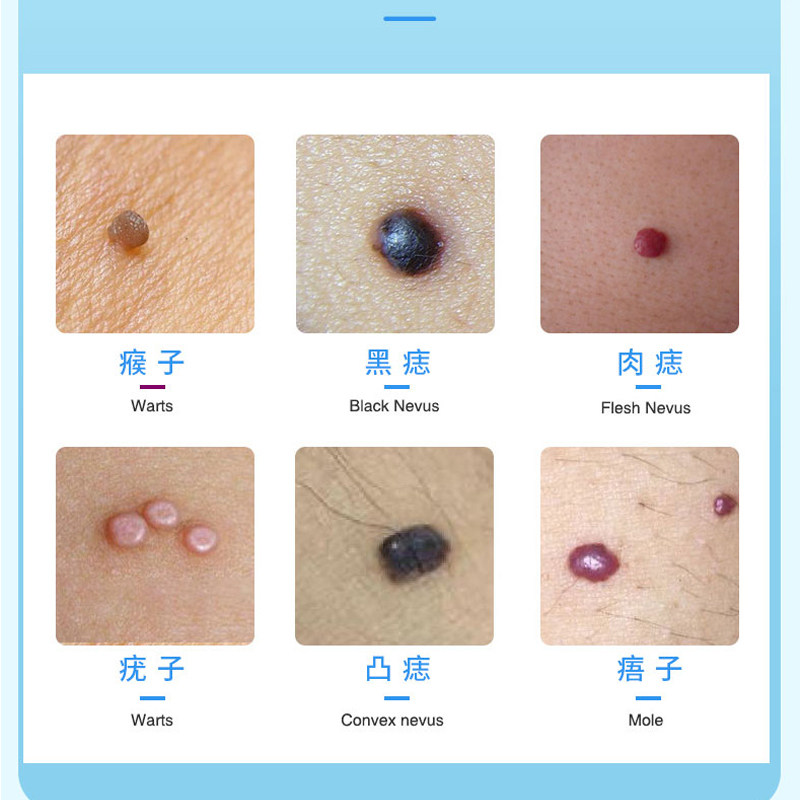 点痣膏祛痣点痦子点痣藥水不留疤去痣去黑痣无痕官方正品旗舰店_虎窝淘