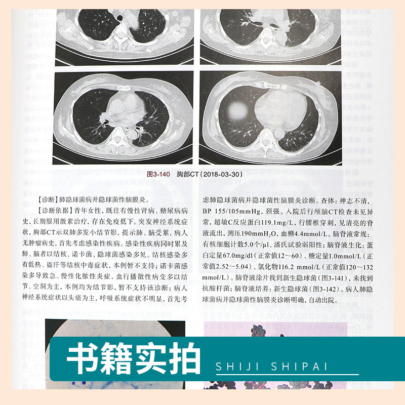 正版2本 肺部细菌感染临床与影像解析+肺部真菌感染临床与影像解析 张嵩 主编 科学出版社 影像医学参考书 肺部影像诊断和鉴别诊断