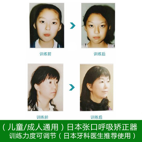 日本唇肌训练器嘴凸口轮匝肌腺样体肥大面容口呼吸矫正睡觉防张嘴 - 图1