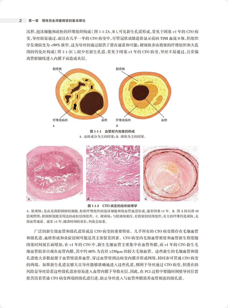 攻克CTO慢性完全闭塞冠状动脉病变介入治疗第2版荆全民等编 OCT病变生理学介入治疗征正向开通技术等操作细节人民卫生出版社-图2