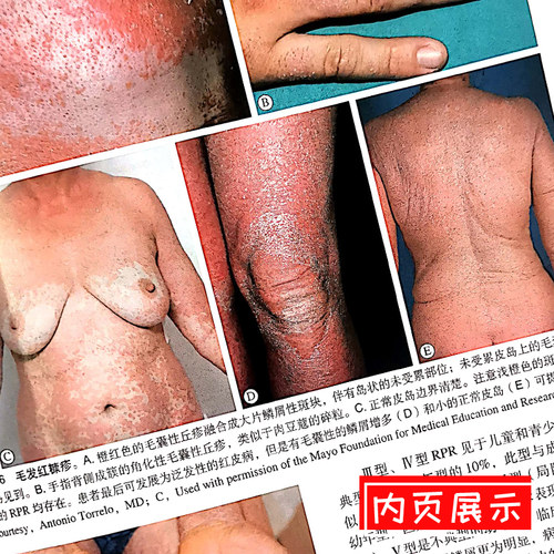 现货 皮肤病学 简装版 第4版第四版 1~5卷 全5卷 朱学骏 王宝玺 孙建方 项蕾红主译 北京大学医学出版社9787565920592皮肤病学 - 图2