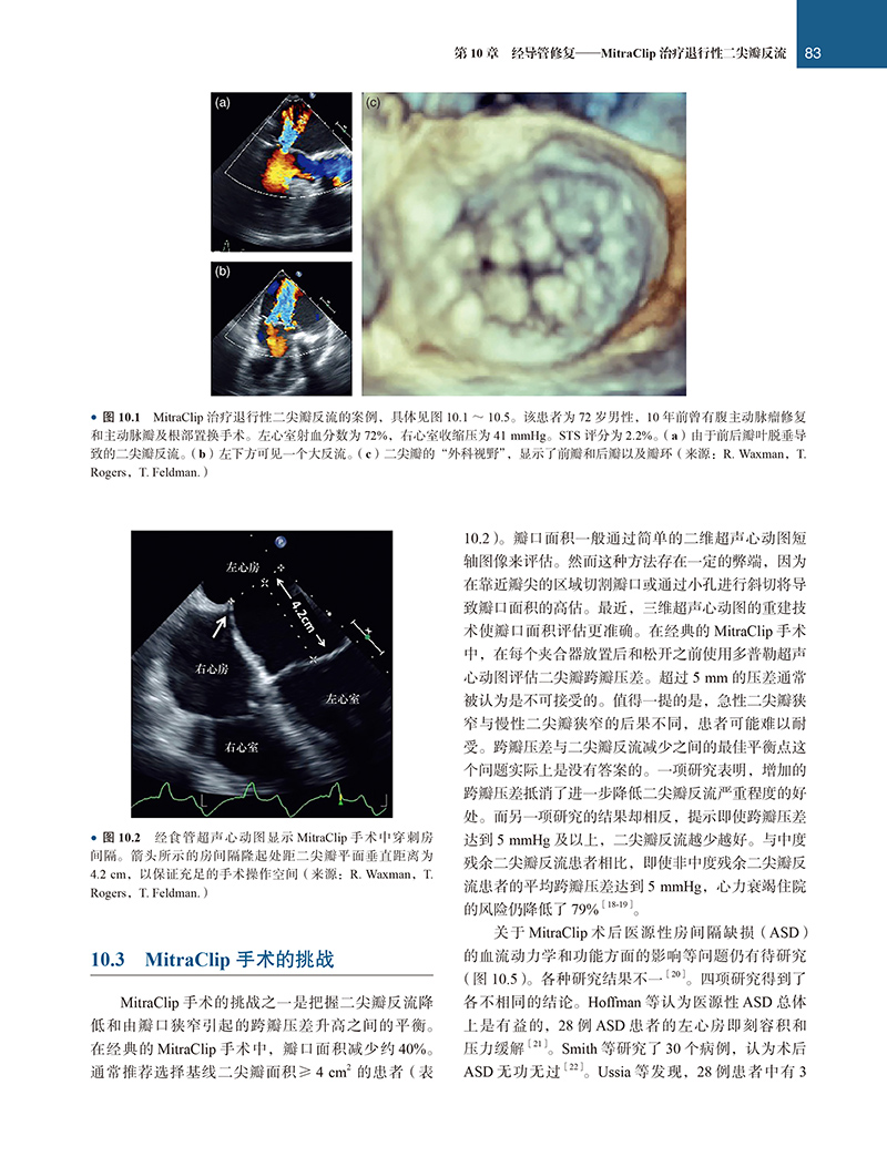 经导管二尖瓣治疗学王建安译国外经典医学名著译丛经导管二尖瓣修复置换手术及辅助技术说明北京大学医学出版社9787565927751-图2