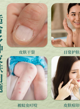 一抹即爽快速止无激素老中医方子