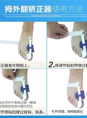 大脚趾拇指夜用外翻矫正器