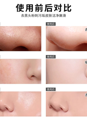竹炭去黑头贴鼻贴撕拉式毛孔粉刺清洁面膜膏控油男女吸黑头脸部