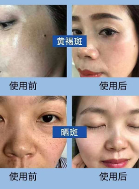 【买5送1】绿色特保10ml控斑淡斑