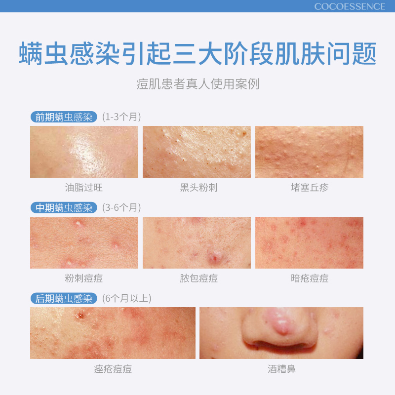 遇见香芬面部祛痘套装油痘肌水乳护肤洗面奶控油非去痘印螨虫膏 遇见香芬面部祛痘套装油痘肌水乳护肤洗面奶控油非去痘印螨虫膏