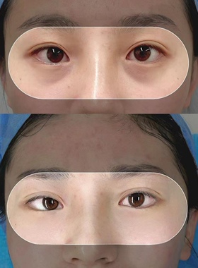 草本泪腺脱垂修复精华 眼部下垂修护紧致提升舒缓新款 加强版