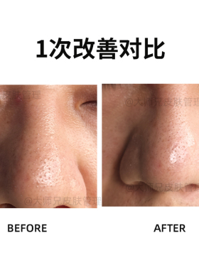 “壬二酸清洁泥膜” 首博尔净澈焕颜白泥面膜10g*8颗/盒