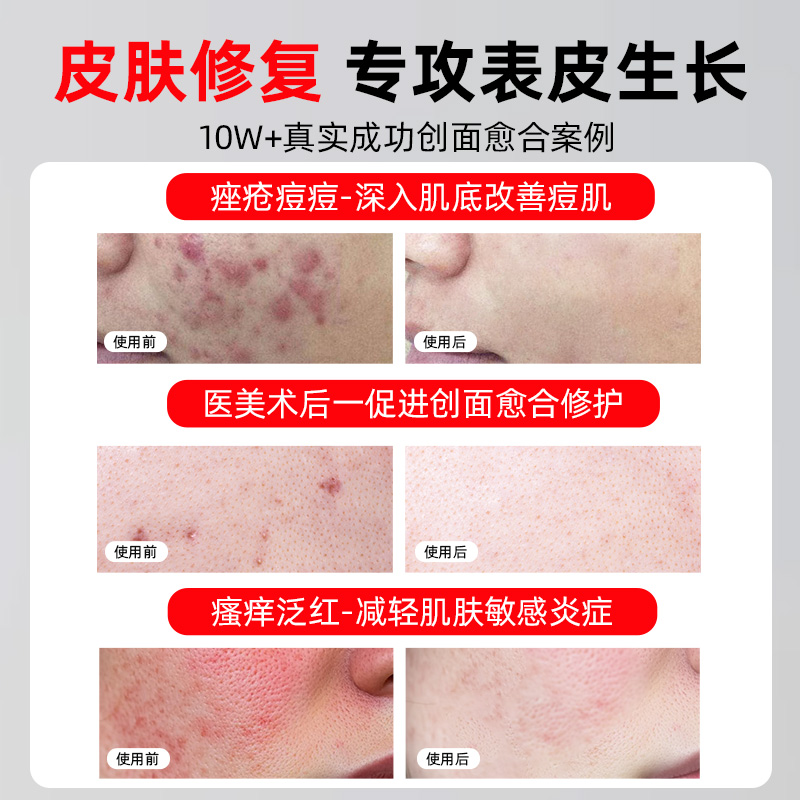 医用重组三型人源化胶原蛋白敷料祛痘印修复淡化痘印坑官方旗舰店