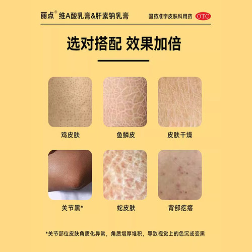 丽点维A酸乳膏医用官方旗舰店毛囊角化疙瘩祛痘药膏软膏鸡皮肤 - 图1