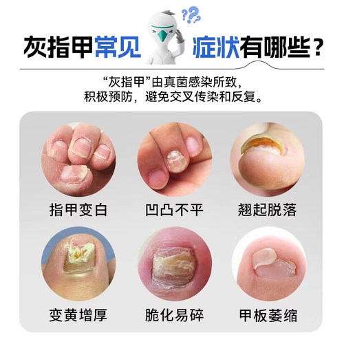 洛芙盐酸阿莫罗芬搽剂2.5ml官方正品灰指甲专用药阿莫罗芬搽剂 - 图1