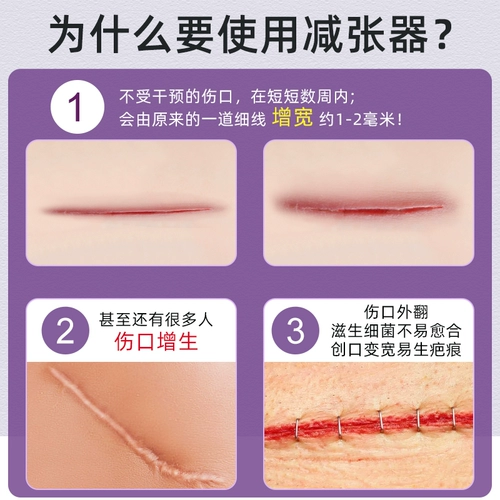 Медицинский пластырь на молнии для уменьшения натяжения кожи, кесарево сечение, заживление рубцов щитовидной железы, хирургическая рана без наложения швов
