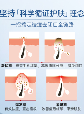 质润15%壬二酸祛痘去黑头