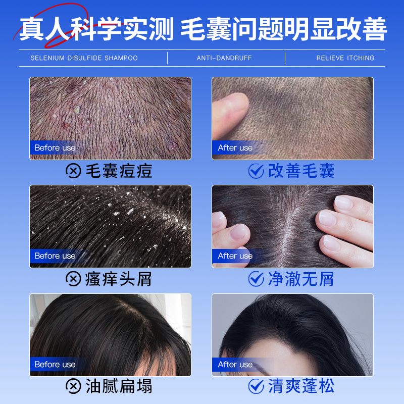 二硫化硒洗发水液控油蓬松去屑止痒头皮毛囊除螨清洁炎洗发露男女