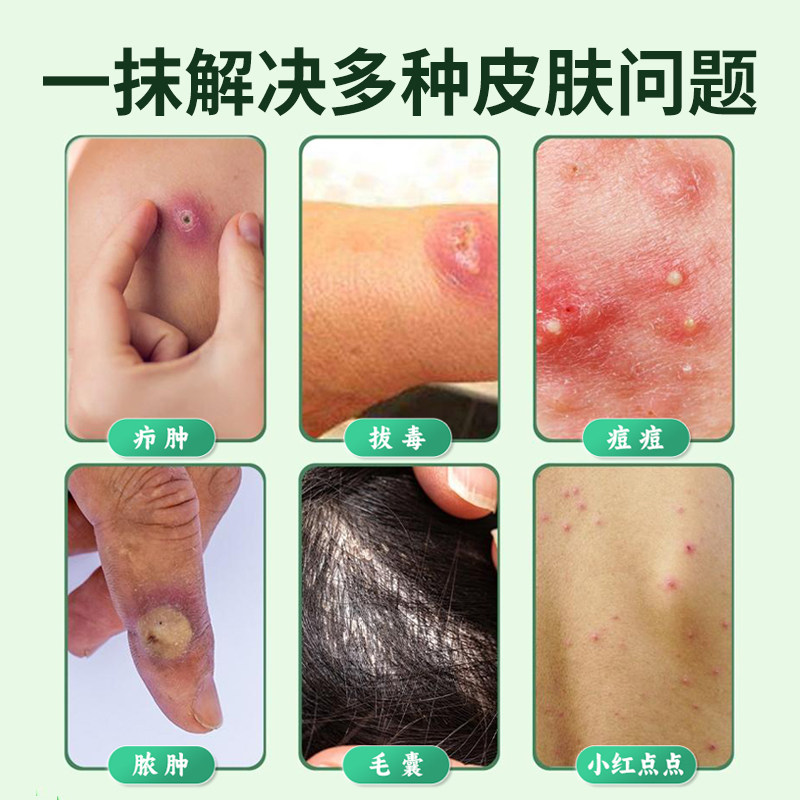 鱼石脂软膏正品官方旗舰店疖肿火疖子毛囊拔毒消肿抑菌预防感染贴,淘宝优惠券,粉丝福利购,淘宝优惠卷