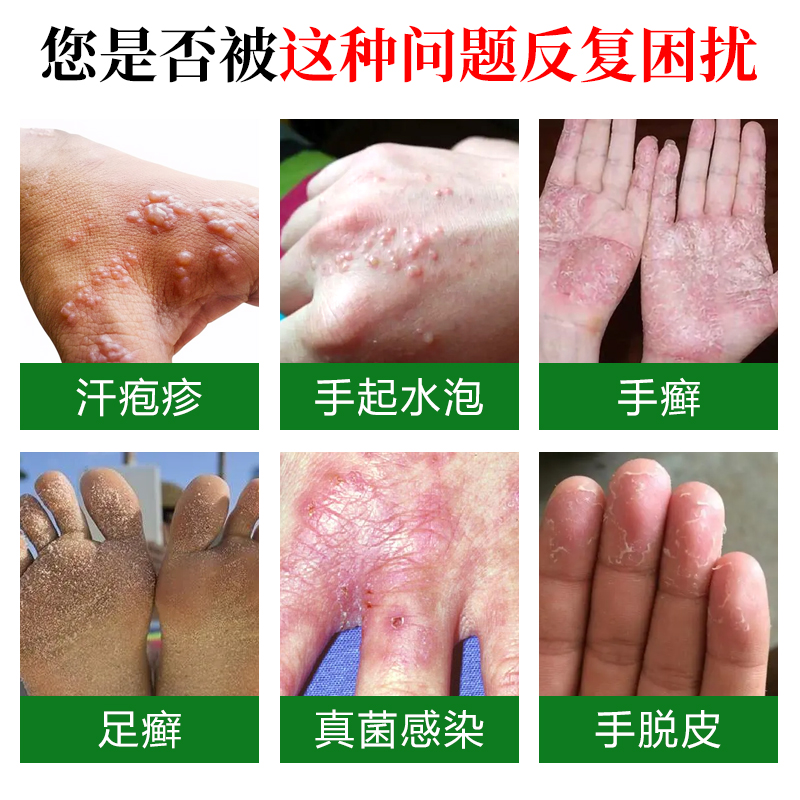 汗泡药膏手上起小水泡脱皮汗状克星止痒真菌感染专用软膏 - 图0