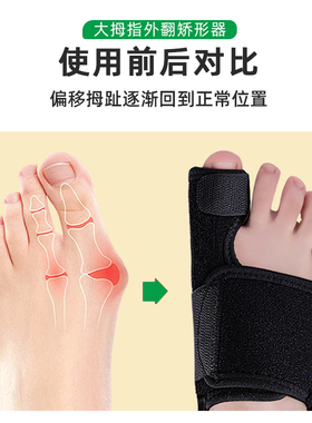 大脚趾外翻矫正器康复固定器