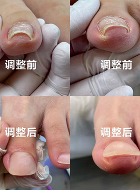 美甲矫正EMA水晶液嵌甲指甲材料笔高透明水晶粉全套沟炎工具套装